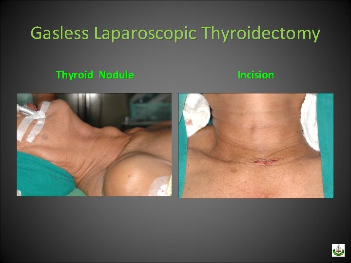 Gasless Laparoscopic Thyroidectomy Thyroid Nodule Incision 