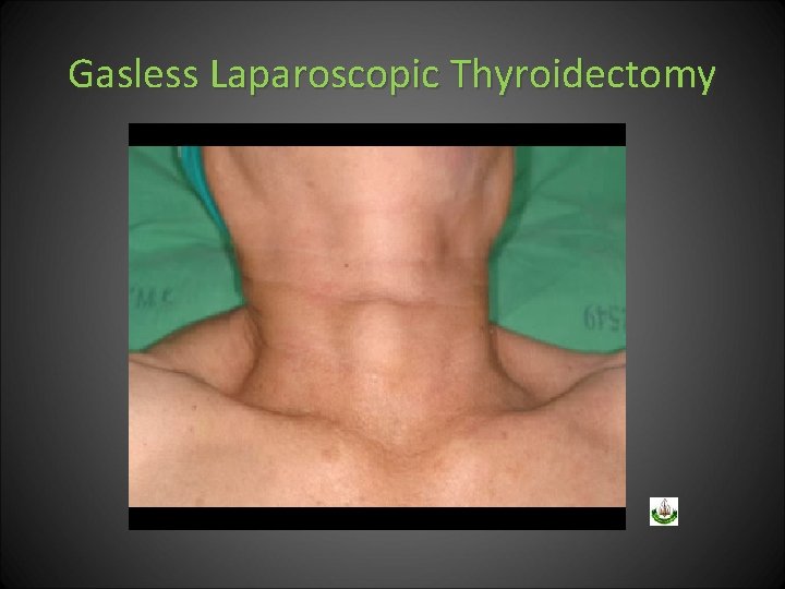 Gasless Laparoscopic Thyroidectomy 