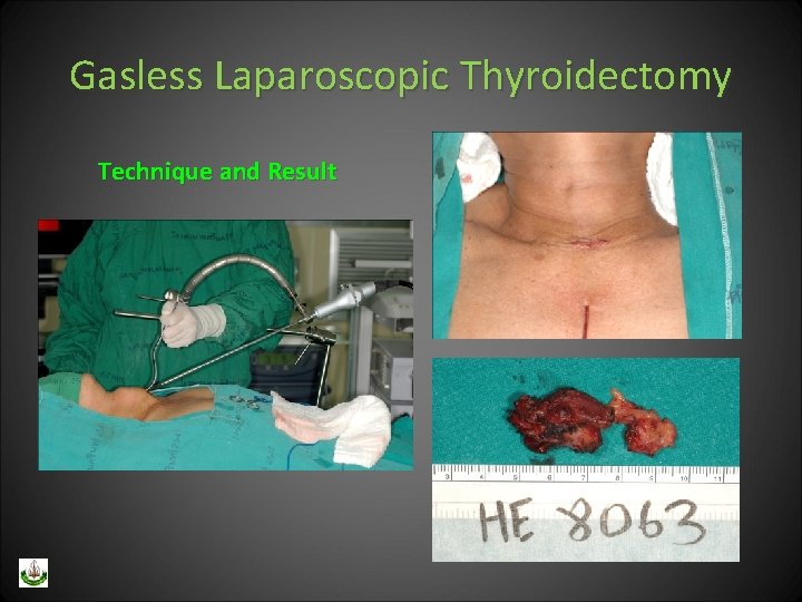 Gasless Laparoscopic Thyroidectomy Technique and Result 