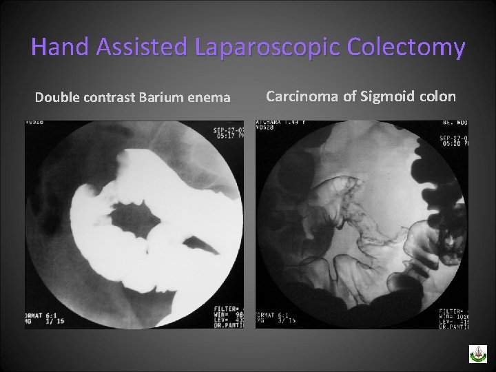 Hand Assisted Laparoscopic Colectomy Double contrast Barium enema Carcinoma of Sigmoid colon 