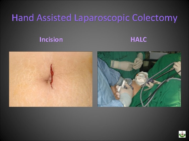 Hand Assisted Laparoscopic Colectomy Incision HALC 