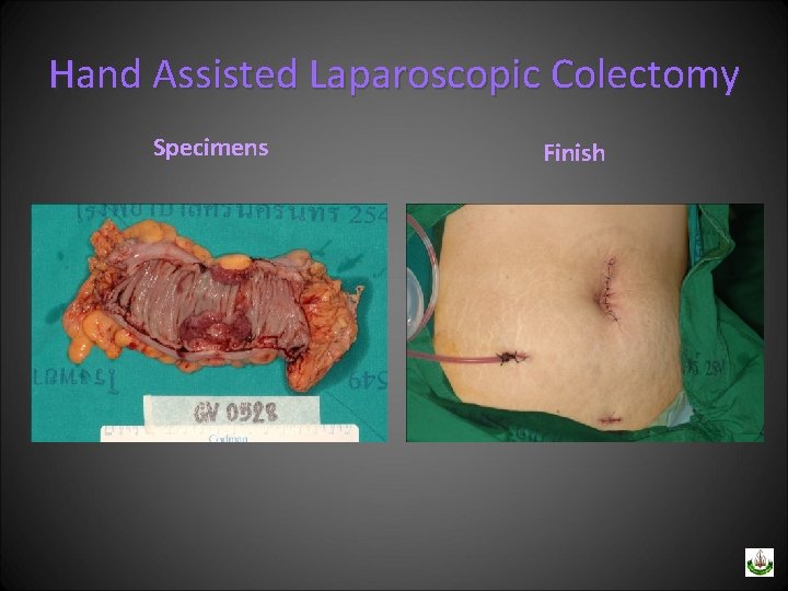 Hand Assisted Laparoscopic Colectomy Specimens Finish 