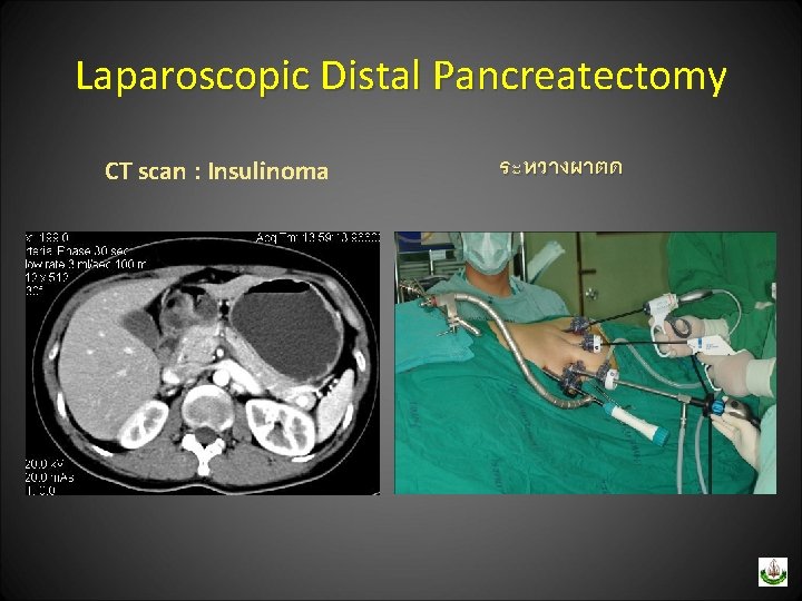Laparoscopic Distal Pancreatectomy CT scan : Insulinoma ระหวางผาตด 