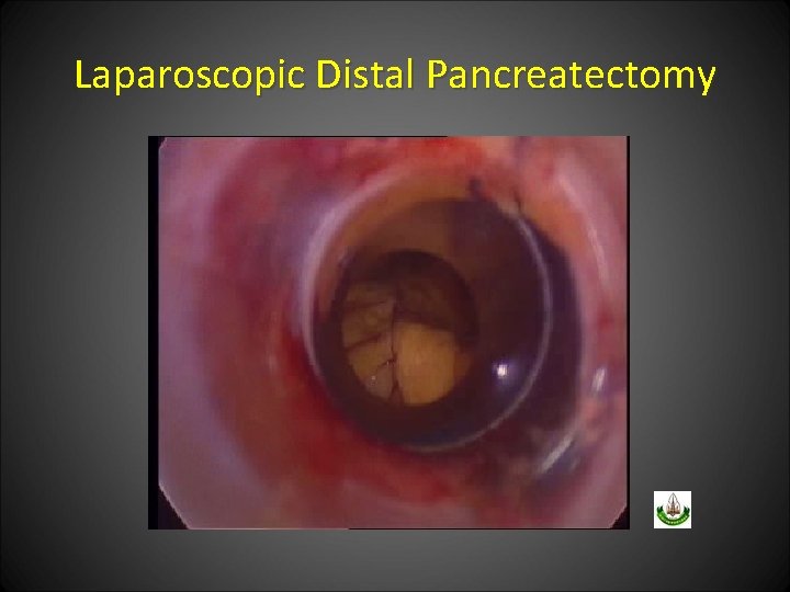 Laparoscopic Distal Pancreatectomy 