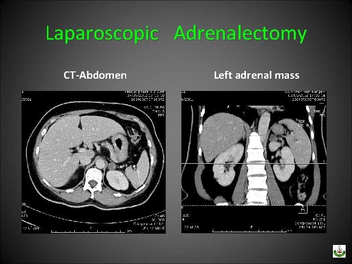 Laparoscopic Adrenalectomy CT-Abdomen Left adrenal mass 