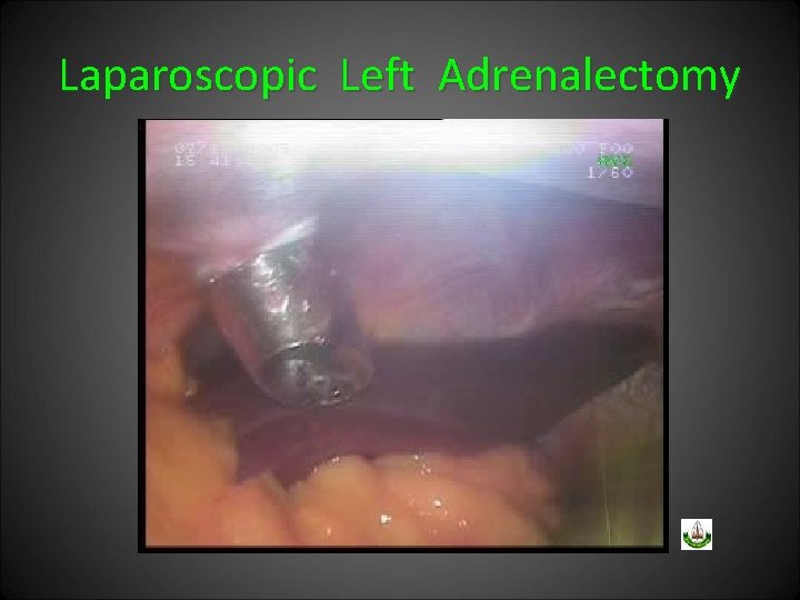 Laparoscopic Left Adrenalectomy 