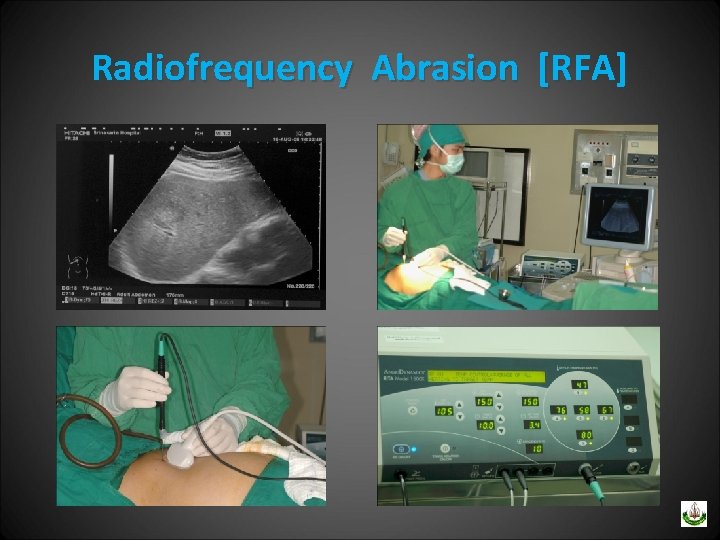 Radiofrequency Abrasion [RFA] 