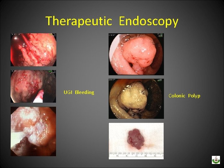 Therapeutic Endoscopy UGI Bleeding Colonic Polyp 