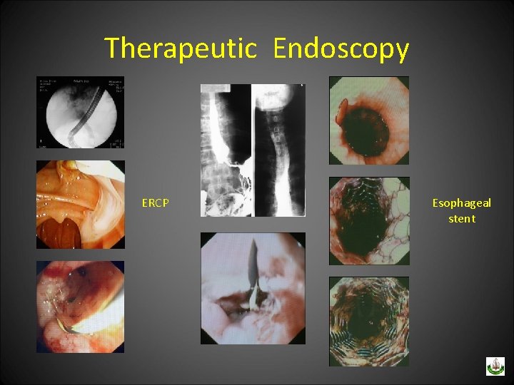 Therapeutic Endoscopy ERCP Esophageal stent 