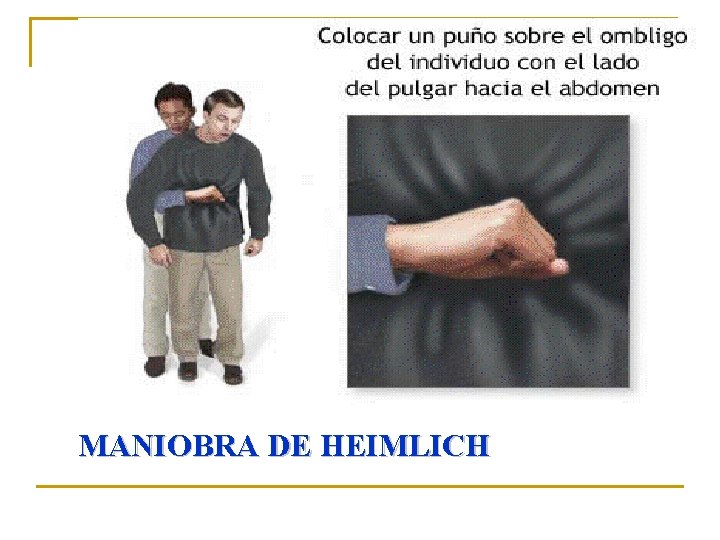 MANIOBRA DE HEIMLICH 