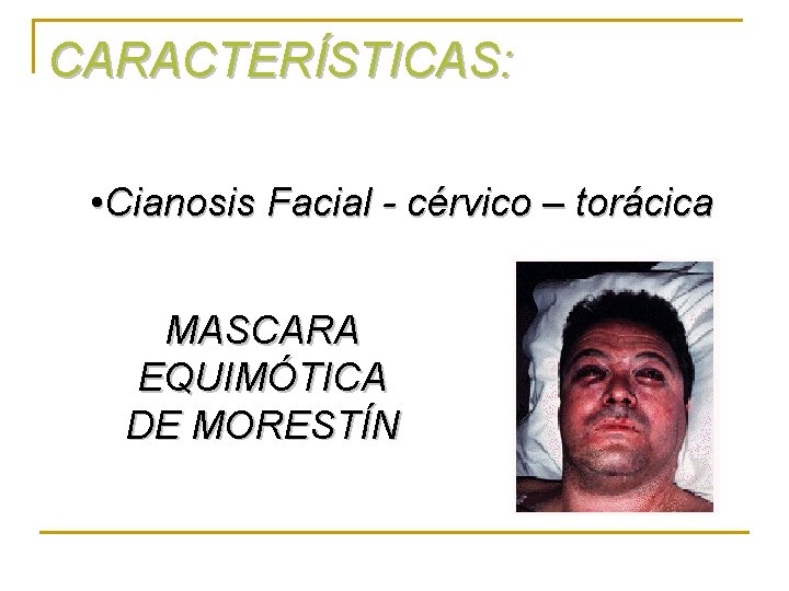 CARACTERÍSTICAS: • Cianosis Facial - cérvico – torácica MASCARA EQUIMÓTICA DE MORESTÍN 