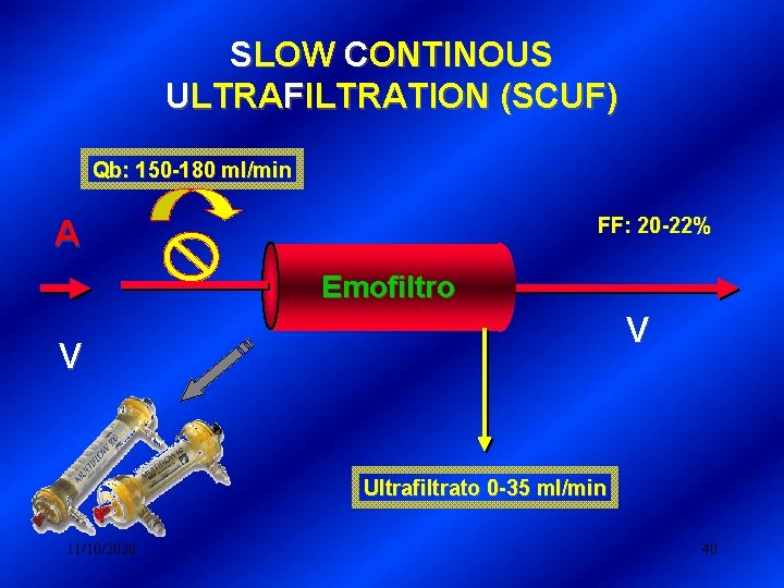 SLOW CONTINOUS ULTRAFILTRATION (SCUF) Qb: 150 -180 ml/min FF: 20 -22% A Emofiltro V