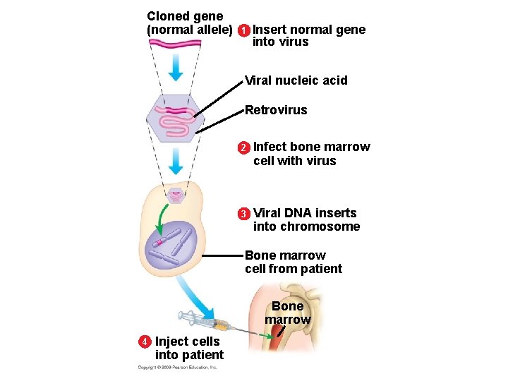 Cloned gene (normal allele) 1 Insert normal gene into virus Viral nucleic acid Retrovirus Cloned gene (normal allele) 1 Insert normal gene into virus Viral nucleic acid Retrovirus