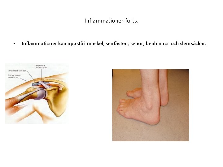 Inflammationer forts. • Inflammationer kan uppstå i muskel, senfästen, senor, benhinnor och slemsäckar. 
