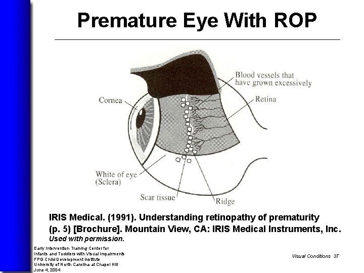 Premature Eye With ROP The premature infant’s eye with ROP has a layer of