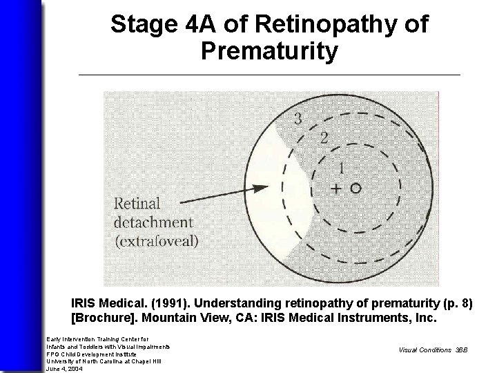 Stage 4 A of Retinopathy of Prematurity Image of subtotal retinal detachment not involving