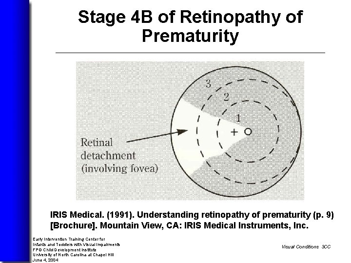 Stage 4 B of Retinopathy of Prematurity Image of subtotal retinal detachment involving the