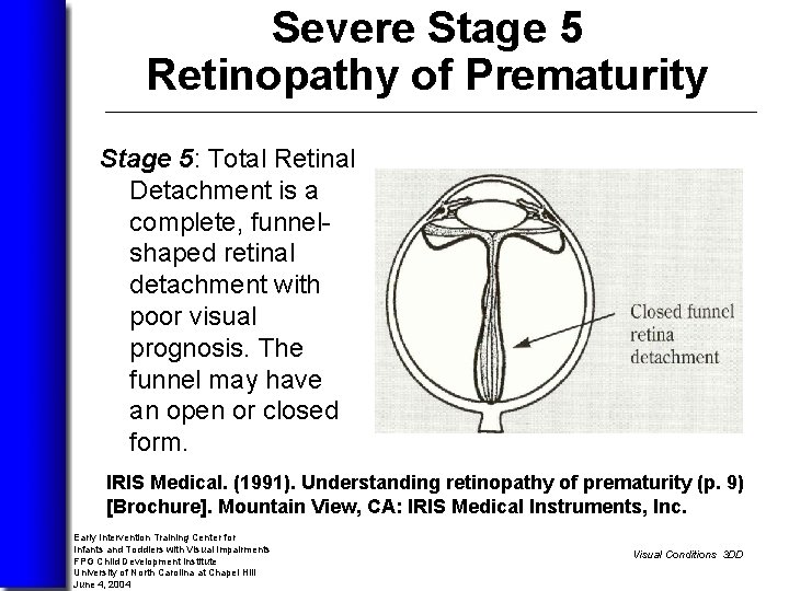 Severe Stage 5 Retinopathy of Prematurity Stage 5: Total Retinal Detachment is a complete,