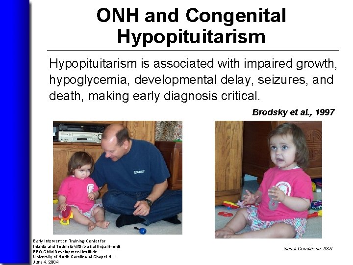 ONH and Congenital Hypopituitarism is associated with impaired growth, hypoglycemia, developmental delay, seizures, and