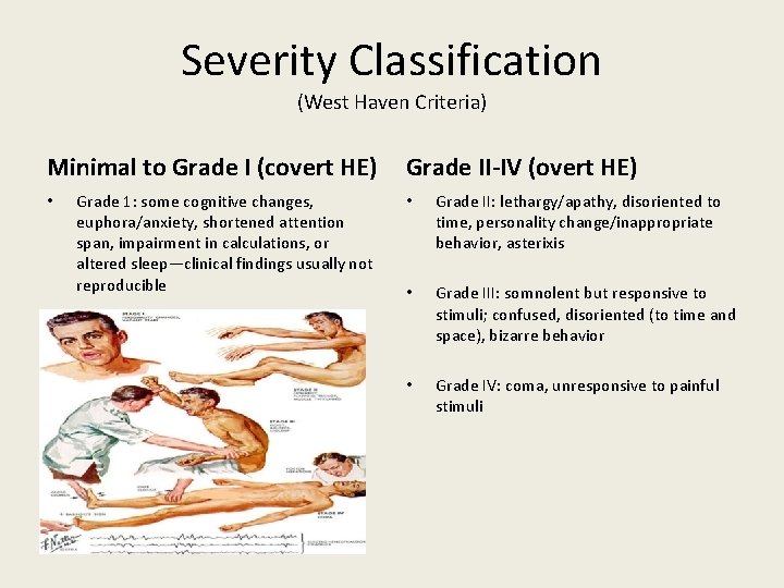 Severity Classification (West Haven Criteria) Minimal to Grade I (covert HE) • Grade 1: