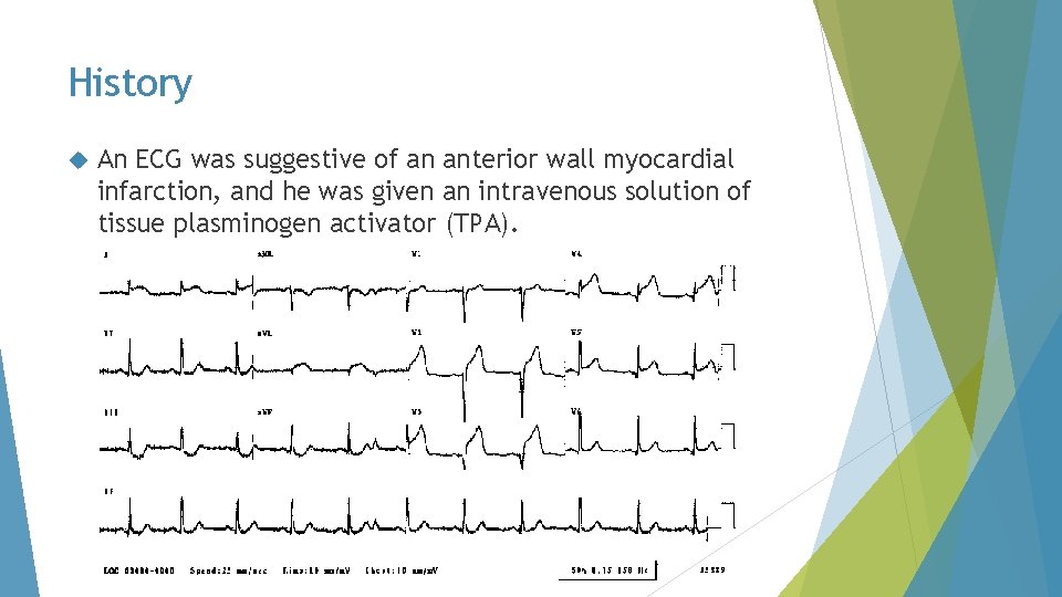 History An ECG was suggestive of an anterior wall myocardial infarction, and he was