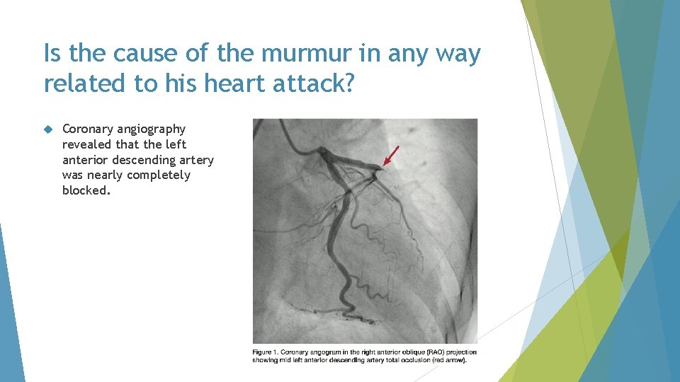 Is the cause of the murmur in any way related to his heart attack?