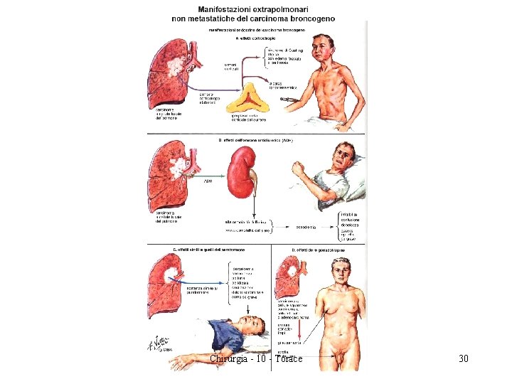 Chirurgia - 10 - Torace 30 