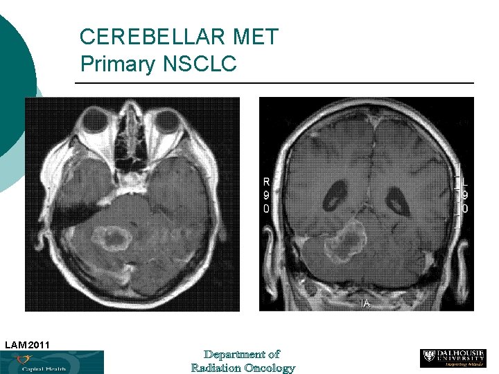CEREBELLAR MET Primary NSCLC LAM 2011 