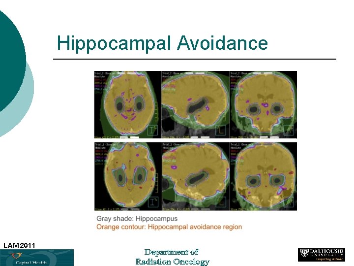 Hippocampal Avoidance LAM 2011 36 
