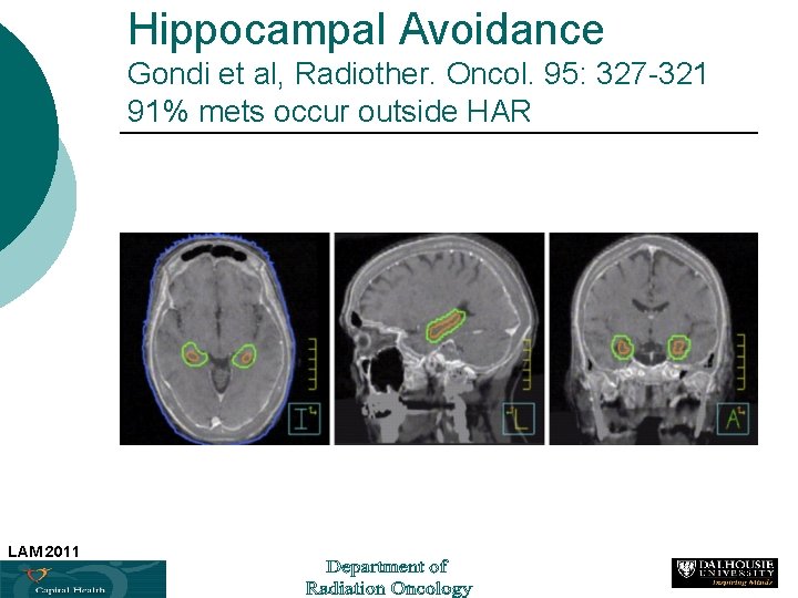 Hippocampal Avoidance Gondi et al, Radiother. Oncol. 95: 327 -321 91% mets occur outside