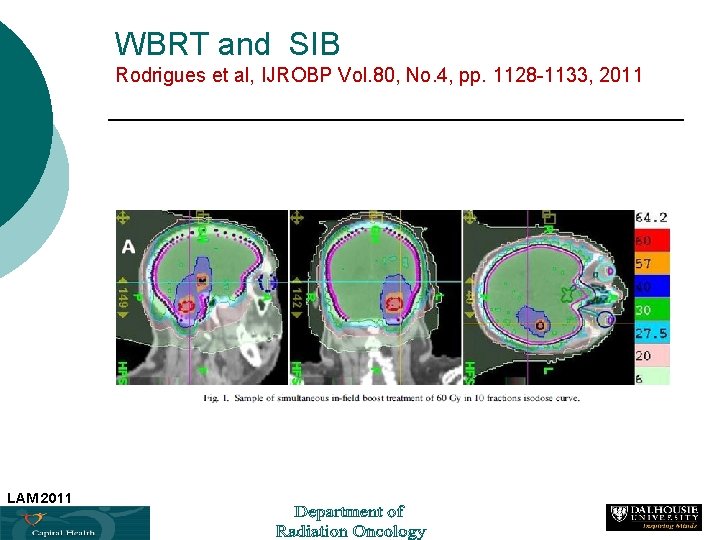 WBRT and SIB Rodrigues et al, IJROBP Vol. 80, No. 4, pp. 1128 -1133,