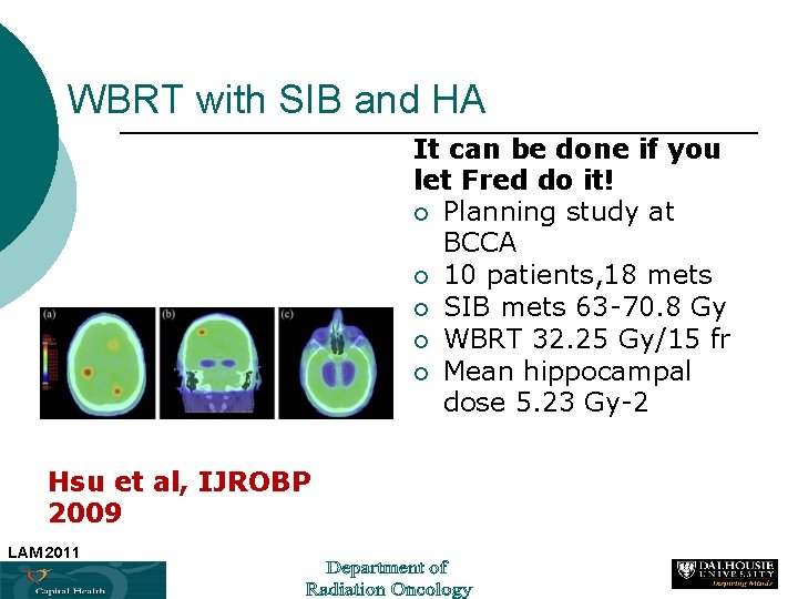 WBRT with SIB and HA It can be done if you let Fred do