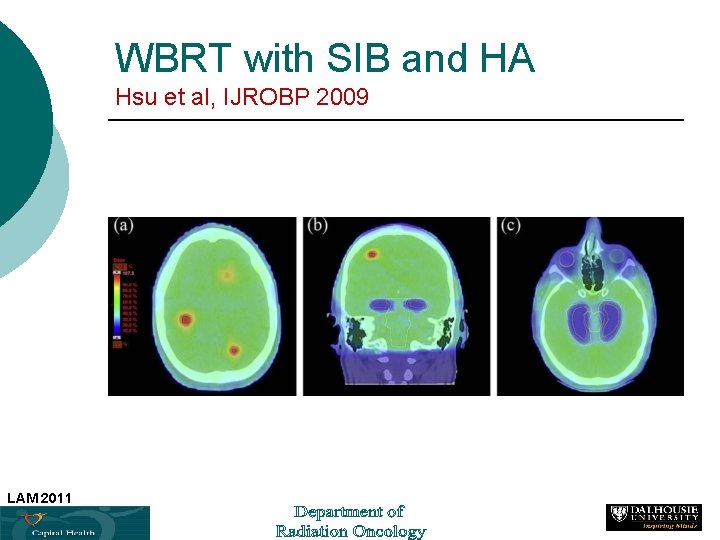 WBRT with SIB and HA Hsu et al, IJROBP 2009 LAM 2011 47 