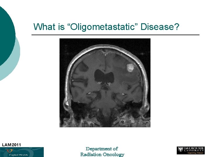 What is “Oligometastatic” Disease? LAM 2011 7 