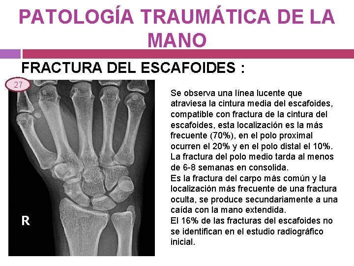 PATOLOGÍA TRAUMÁTICA DE LA MANO FRACTURA DEL ESCAFOIDES : 27 Se observa una línea