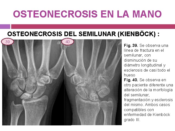 OSTEONECROSIS EN LA MANO OSTEONECROSIS DEL SEMILUNAR (KIENBÖCK) : 39 40 Fig. 39. Se