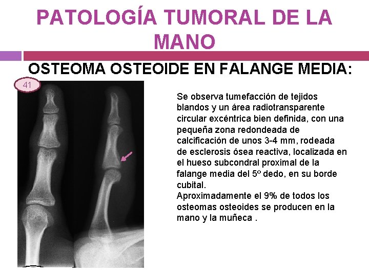 PATOLOGÍA TUMORAL DE LA MANO OSTEOMA OSTEOIDE EN FALANGE MEDIA: 41 Se observa tumefacción