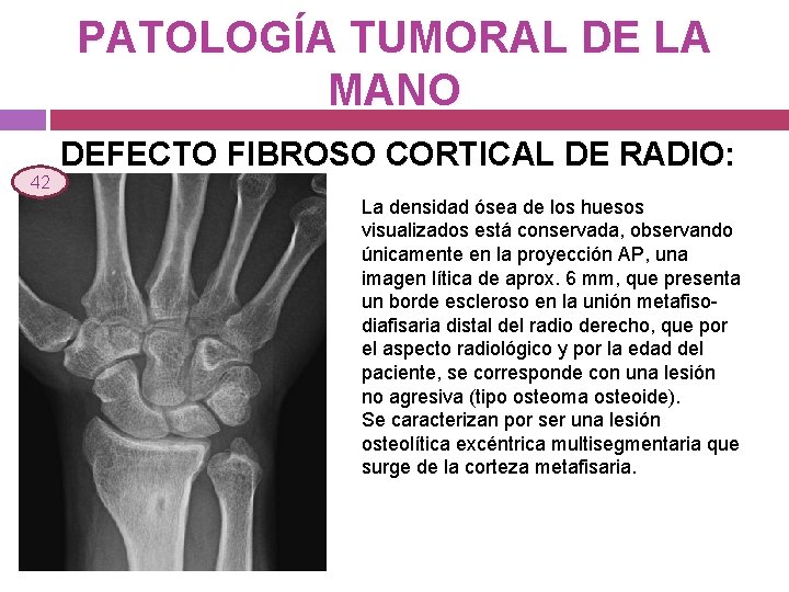 PATOLOGÍA TUMORAL DE LA MANO 42 DEFECTO FIBROSO CORTICAL DE RADIO: La densidad ósea