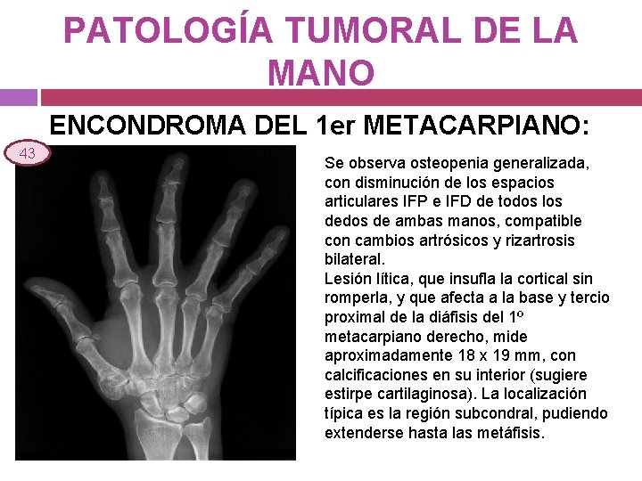 PATOLOGÍA TUMORAL DE LA MANO ENCONDROMA DEL 1 er METACARPIANO: 43 Se observa osteopenia