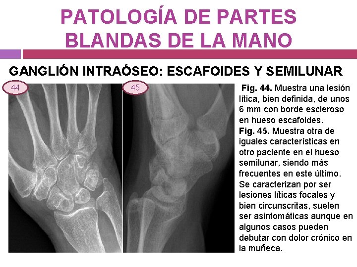 PATOLOGÍA DE PARTES BLANDAS DE LA MANO GANGLIÓN INTRAÓSEO: ESCAFOIDES Y SEMILUNAR 44 45