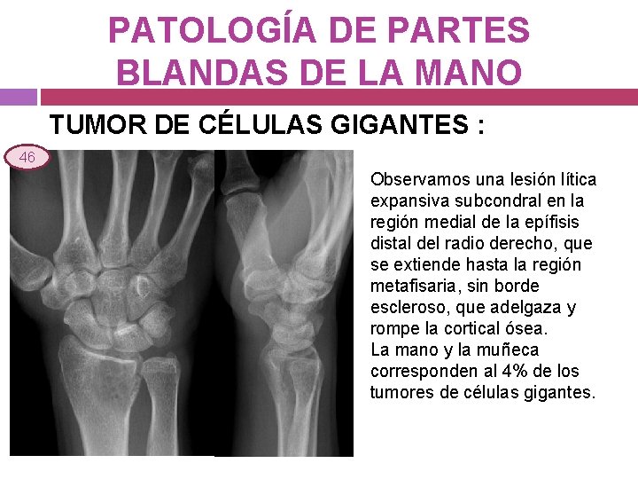 PATOLOGÍA DE PARTES BLANDAS DE LA MANO TUMOR DE CÉLULAS GIGANTES : 46 Observamos