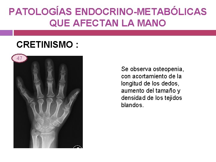 PATOLOGÍAS ENDOCRINO-METABÓLICAS QUE AFECTAN LA MANO CRETINISMO : 47 Se observa osteopenia, con acortamiento