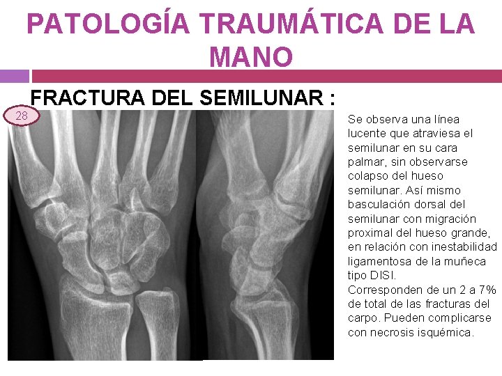 PATOLOGÍA TRAUMÁTICA DE LA MANO 28 FRACTURA DEL SEMILUNAR : Se observa una línea