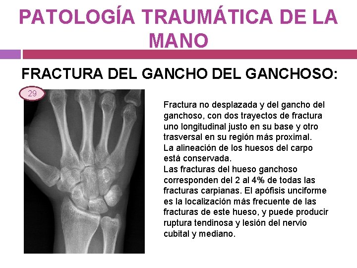 PATOLOGÍA TRAUMÁTICA DE LA MANO FRACTURA DEL GANCHOSO: 29 Fractura no desplazada y del