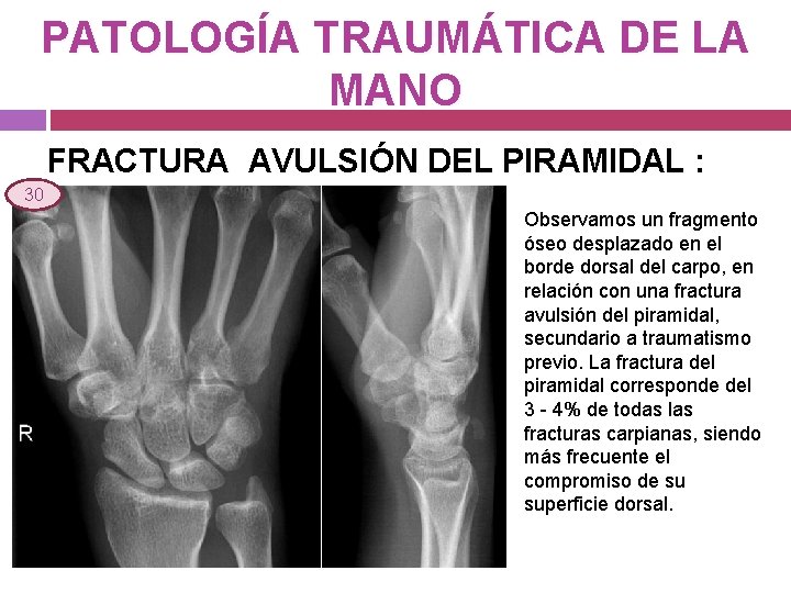 PATOLOGÍA TRAUMÁTICA DE LA MANO FRACTURA AVULSIÓN DEL PIRAMIDAL : 30 Observamos un fragmento