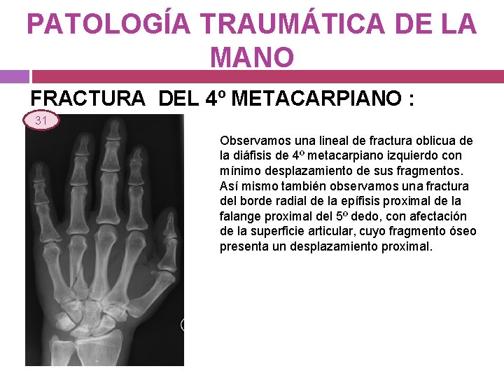 PATOLOGÍA TRAUMÁTICA DE LA MANO FRACTURA DEL 4º METACARPIANO : 31 Observamos una lineal