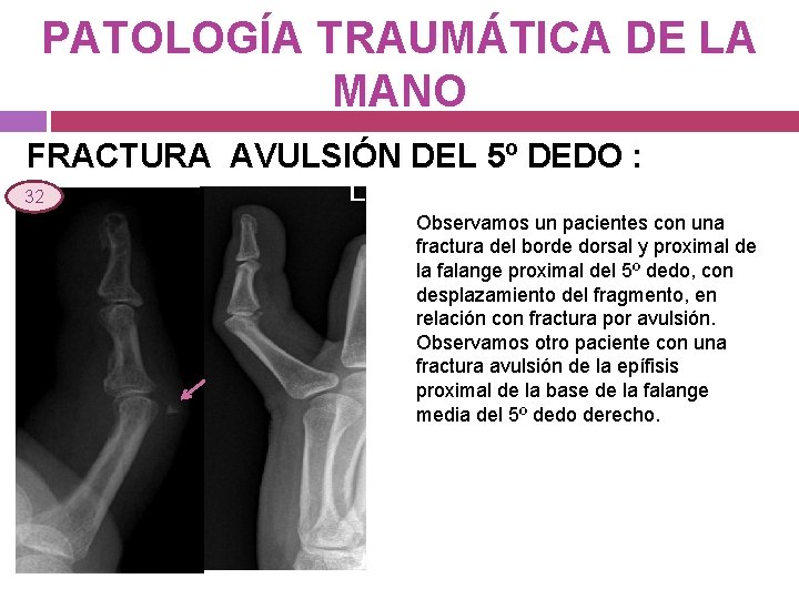 PATOLOGÍA TRAUMÁTICA DE LA MANO FRACTURA AVULSIÓN DEL 5º DEDO : 32 Observamos un