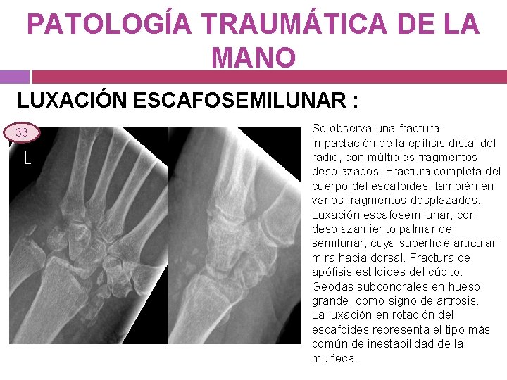 PATOLOGÍA TRAUMÁTICA DE LA MANO LUXACIÓN ESCAFOSEMILUNAR : 33 Se observa una fracturaimpactación de