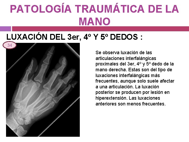 PATOLOGÍA TRAUMÁTICA DE LA MANO LUXACIÓN DEL 3 er, 4º Y 5º DEDOS :