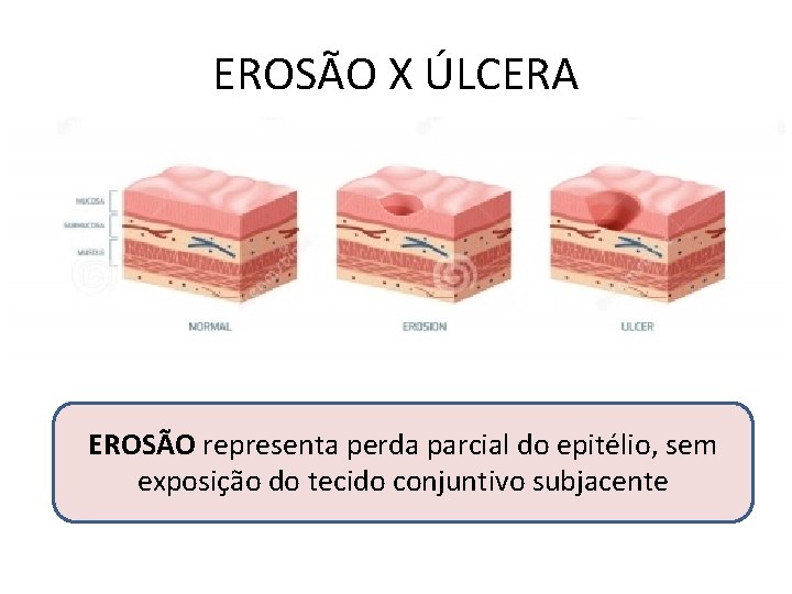 EROSÃO X ÚLCERA EROSÃO representa perda parcial do epitélio, sem exposição do tecido conjuntivo